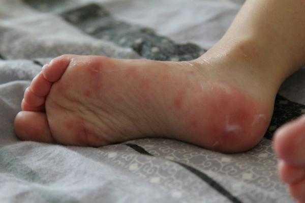 Аллергия на икрах ног фото